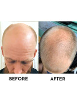 100% Genuine Neo Hair Lotion before & after pic 1