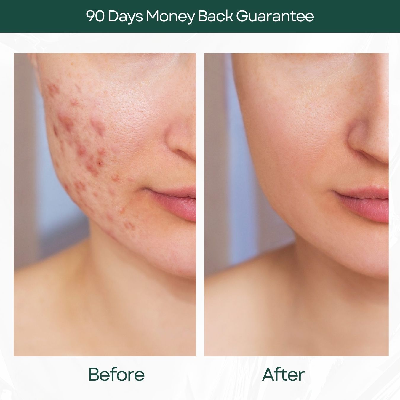 Face And Acne Soap Bar (50g)