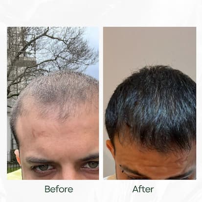 Before and After
