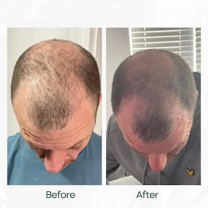 Before and After