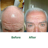 Post Hair Transplant Shampoo