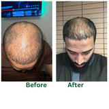 Post Hair Transplant Shampoo