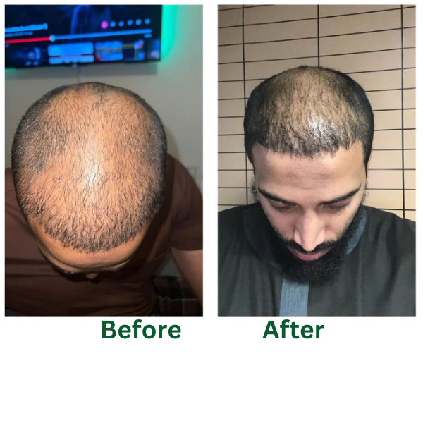 Post Hair Transplant Shampoo