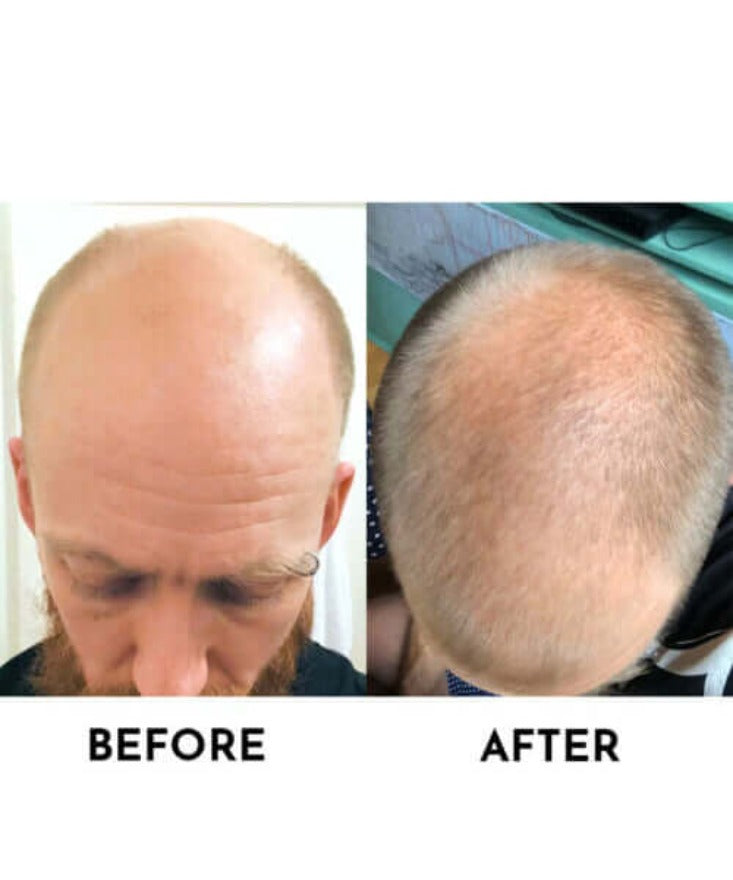 100% Genuine Neo Hair Lotion before & after pic 1