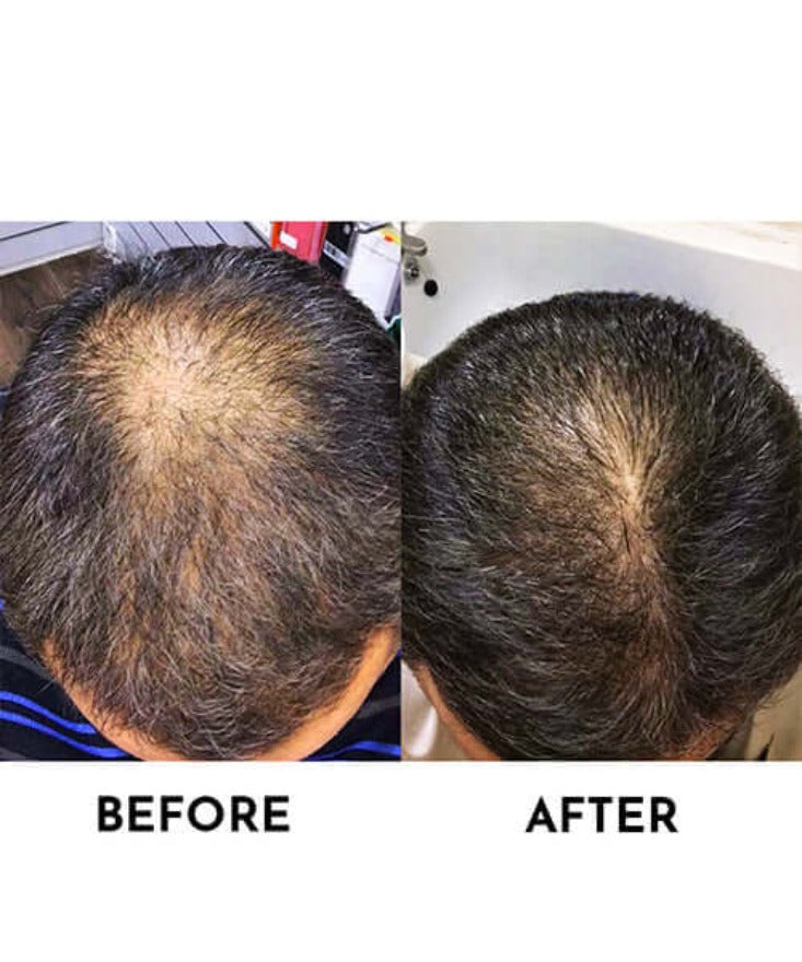 100% Genuine Neo Hair Lotion before & after pic 2